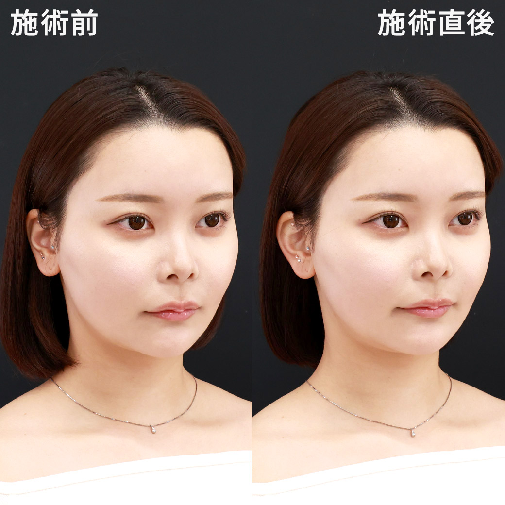立ち耳/ヒアルロン酸注射：その他の症例写真 施術前後 