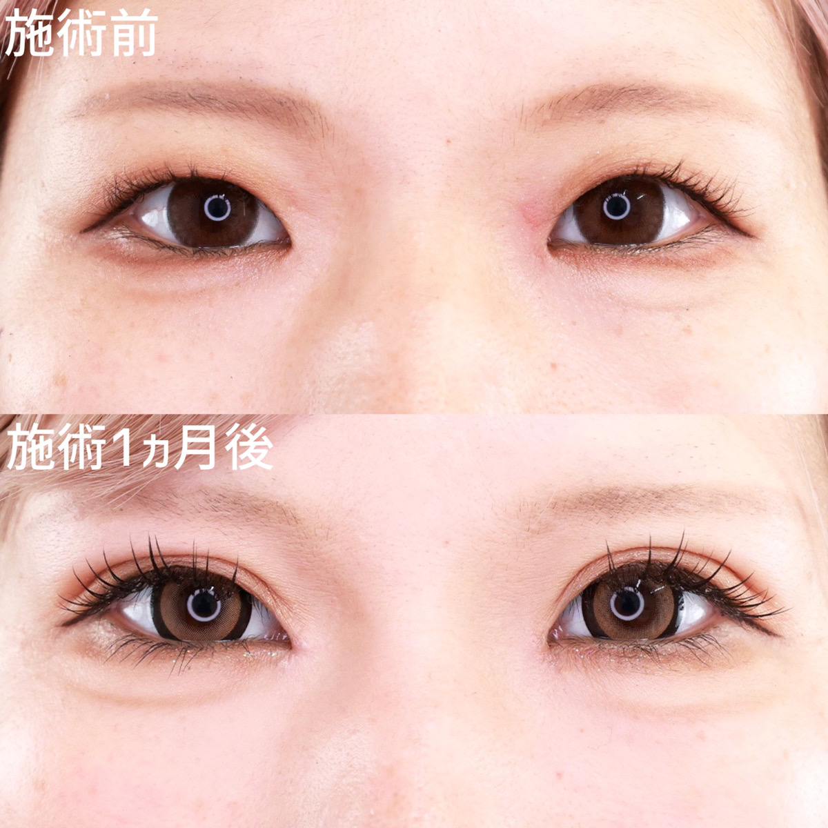 【二重埋没法×目頭切開術】憧れのパッチリと華やかな平行二重に!