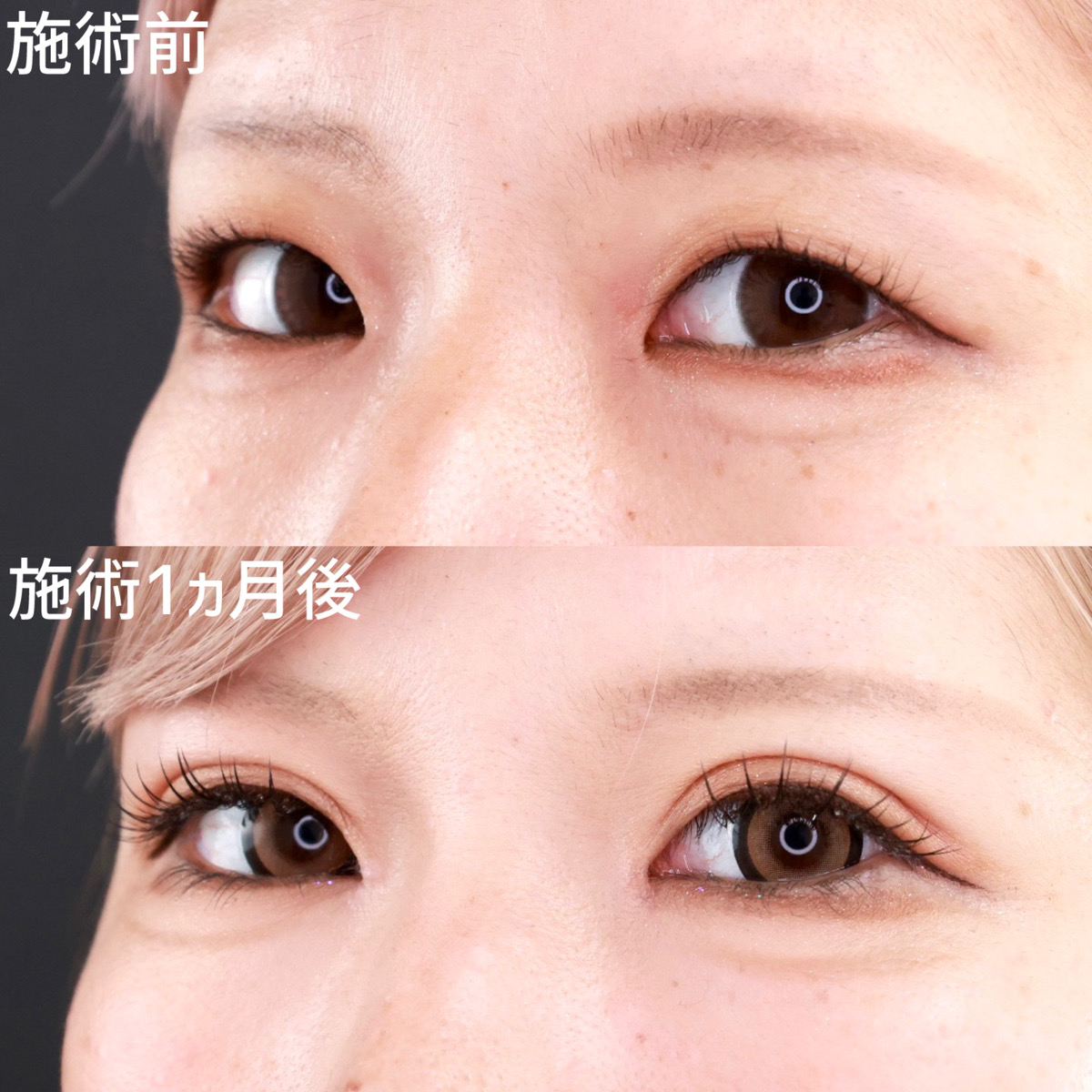 二重埋没法/目頭切開術の症例写真 施術前後 