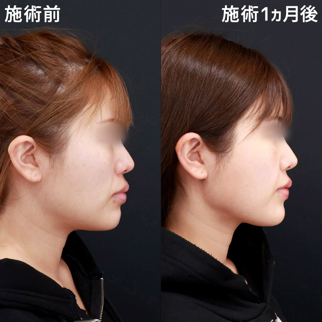 TAC式 ツヤ肌コラーゲンリフト®/顔の脂肪吸引/ジョールファット除去の症例写真 施術前後