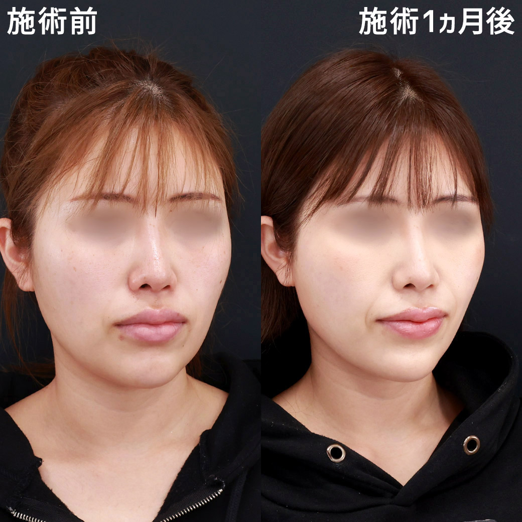 TAC式 ツヤ肌コラーゲンリフト®/顔の脂肪吸引/ジョールファット除去の症例写真 施術前後