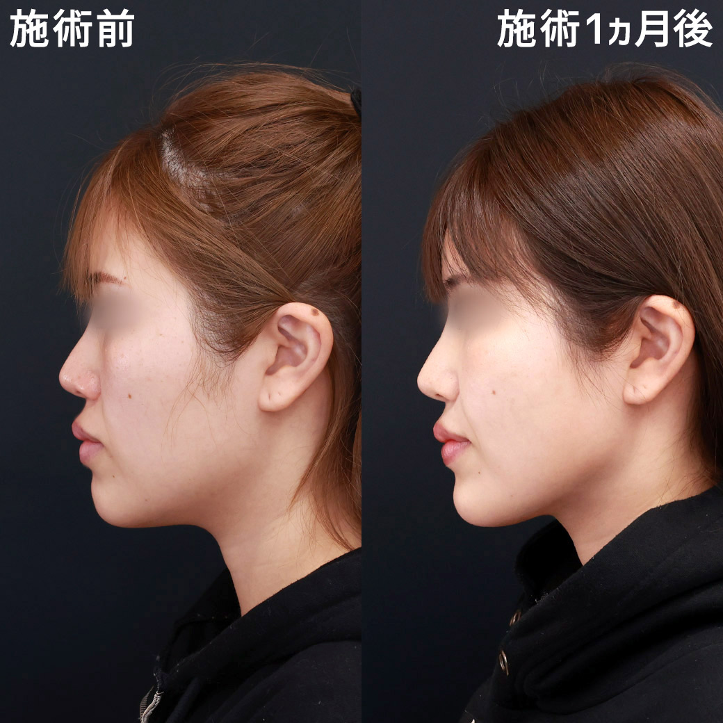 TAC式 ツヤ肌コラーゲンリフト®/顔の脂肪吸引/ジョールファット除去の症例写真 施術前後