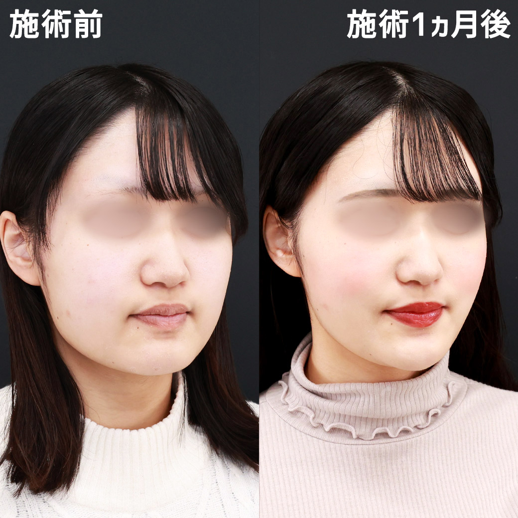 TAC式 ツヤ肌コラーゲンリフト®/小顔整形｜パーフェクトフェイスライン/顔の脂肪吸引の症例写真 施術前後 