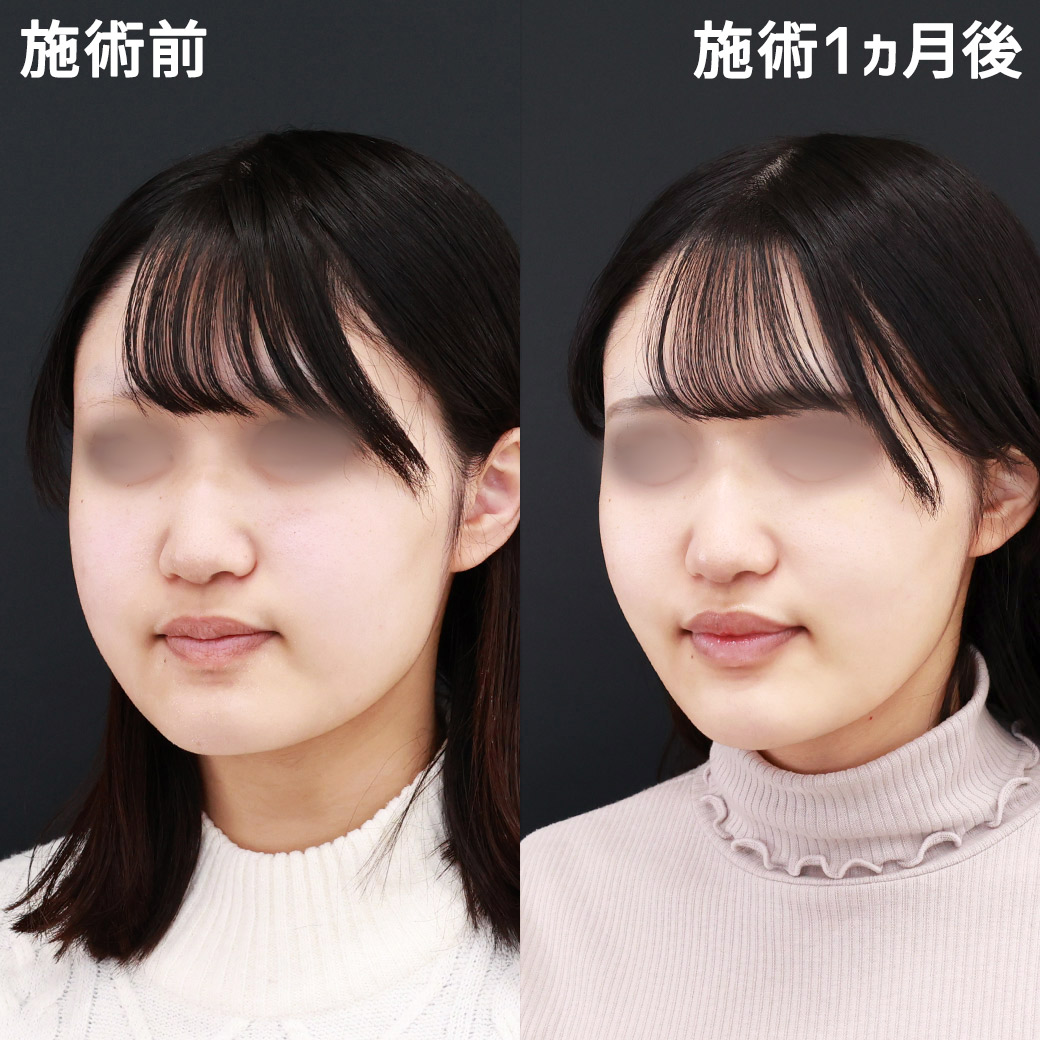 【パーフェクトフェイスライン】ムチっと出る頬肉を無くし、美しい卵型の輪郭に