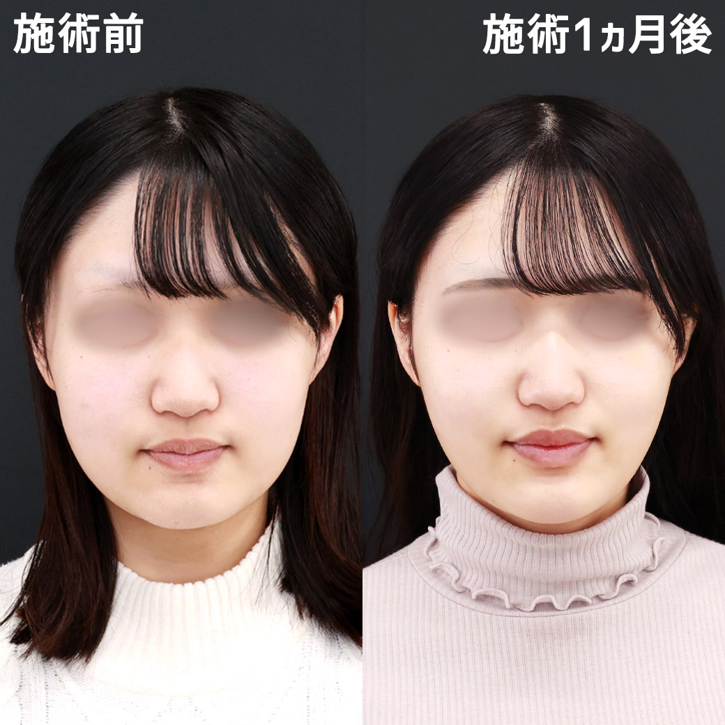 TAC式 ツヤ肌コラーゲンリフト®/小顔整形｜パーフェクトフェイスライン/顔の脂肪吸引の症例写真 施術前後 