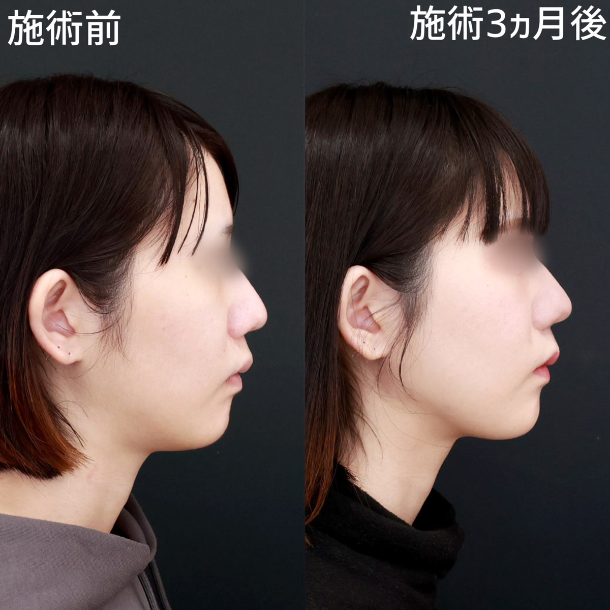 【顎下脂肪吸引×糸リフト極】フェイスラインを、クッキリと出現させる！