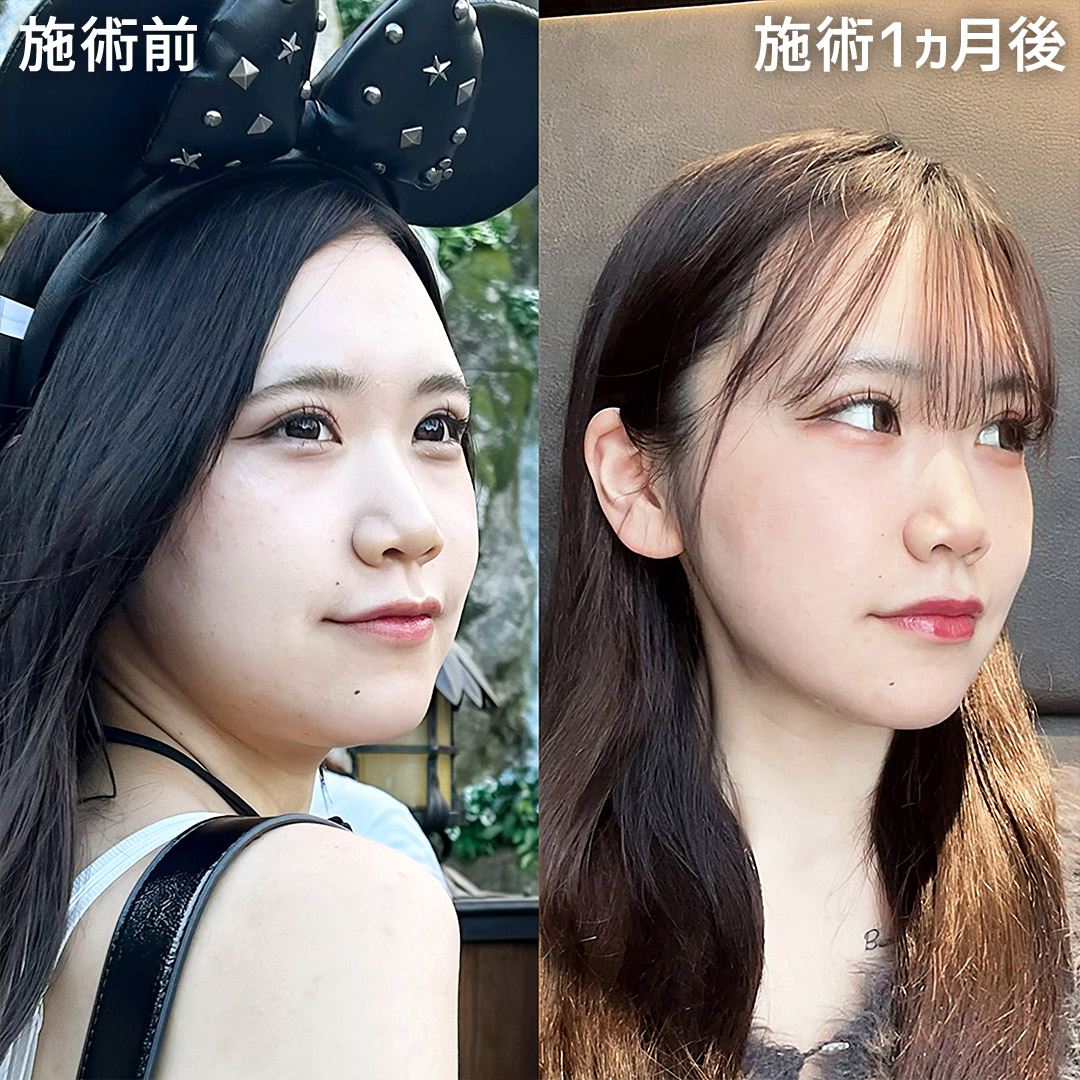 【糸リフト極&顎下脂肪吸引】クッキリと際立つ、360度美しいフェイスラインを形成