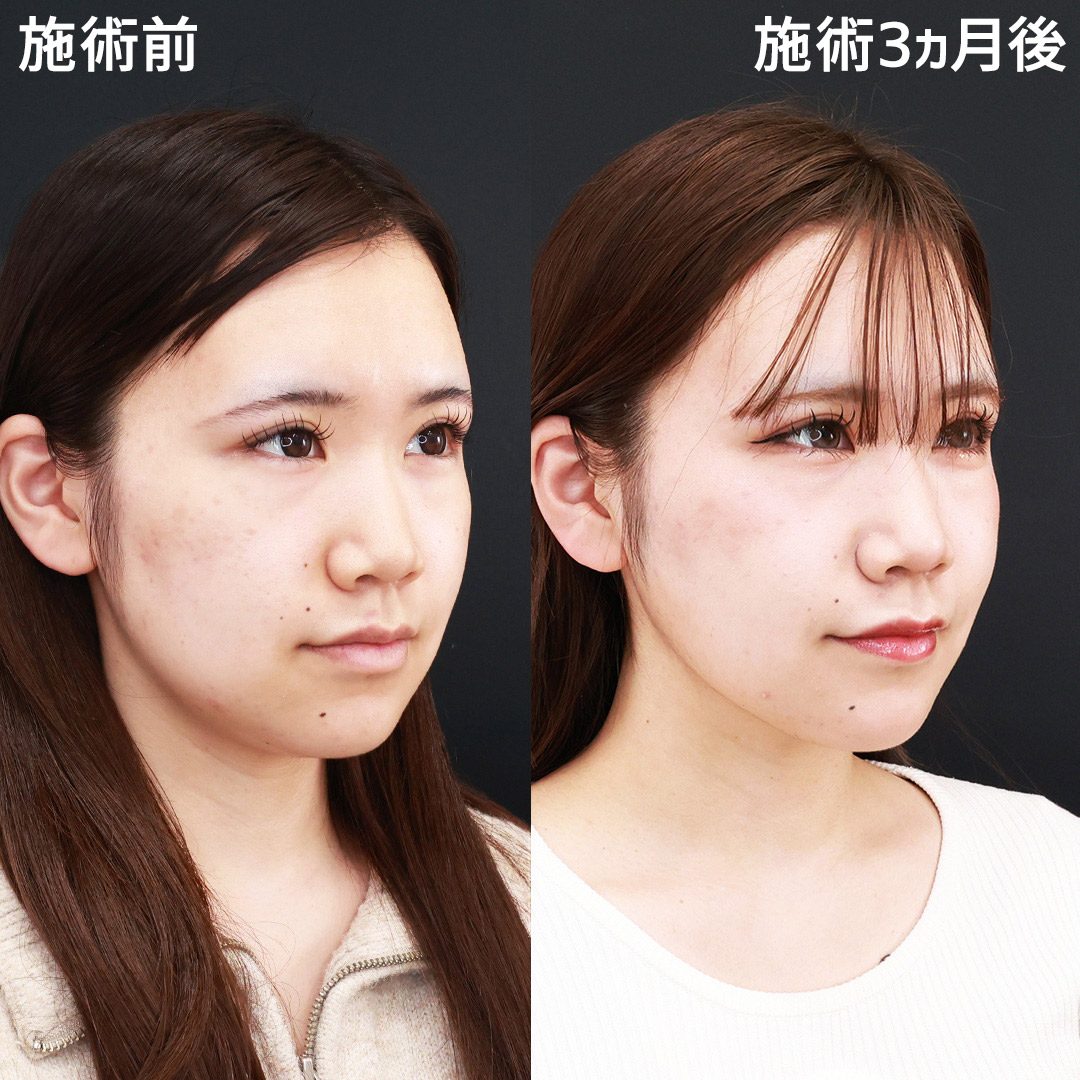 TAC式 ツヤ肌コラーゲンリフト®/ジョールファット除去/顎下の脂肪吸引の症例写真 施術前後 