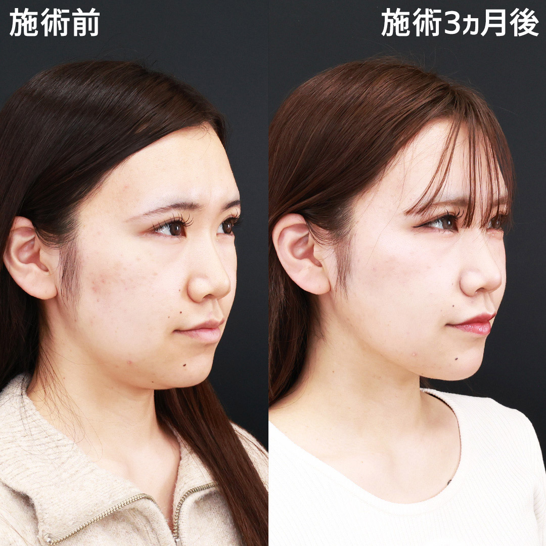 TAC式 ツヤ肌コラーゲンリフト®/ジョールファット除去/顎下の脂肪吸引の症例写真 施術前後 