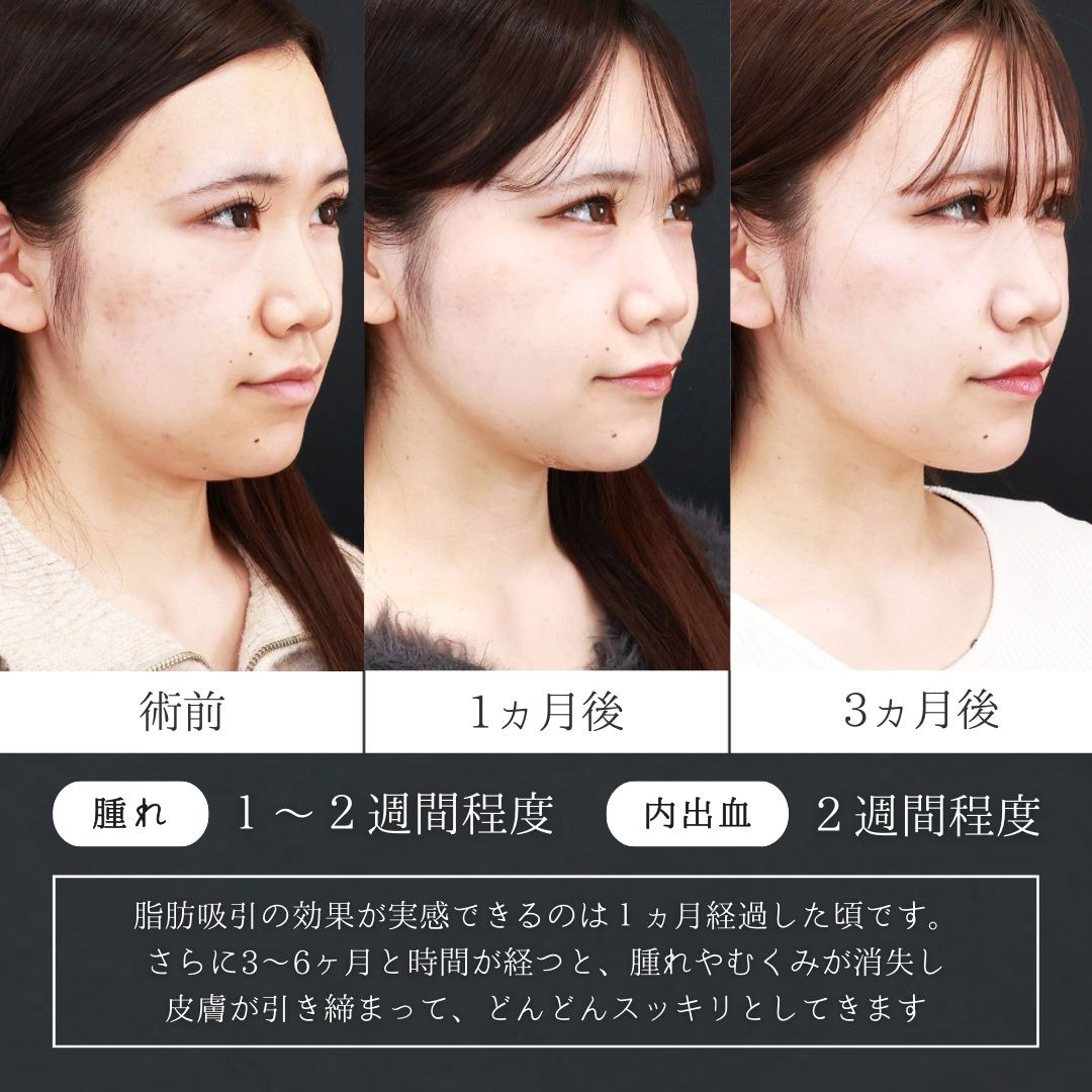 TAC式 ツヤ肌コラーゲンリフト®/ジョールファット除去/顎下の脂肪吸引の症例写真 施術前後 