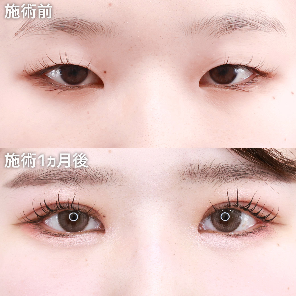 【二重埋没法&目頭切開&目尻切開&グラマラスライン】目のフル整形で印象激変!