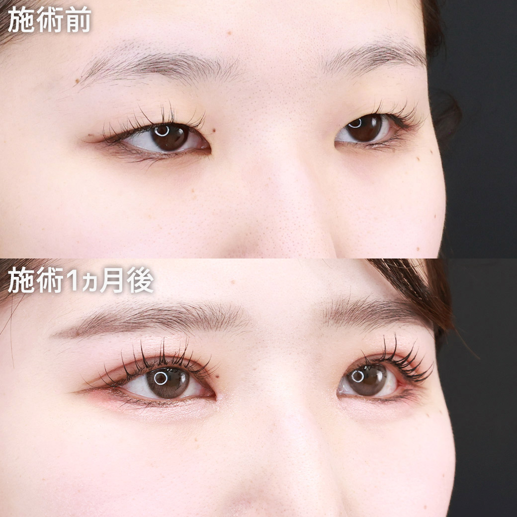 目頭切開術/目尻切開術/二重埋没法の症例写真 施術前後 