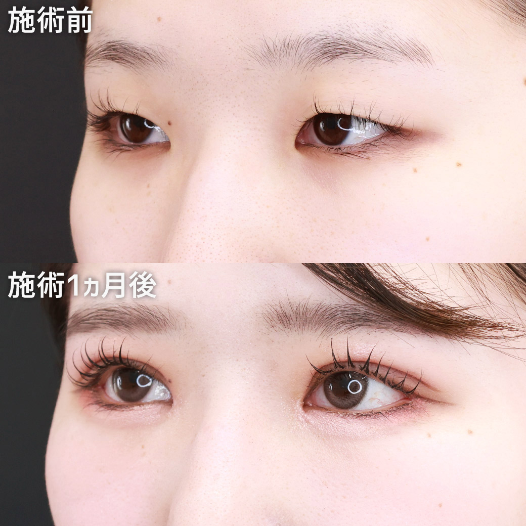 目頭切開術/目尻切開術/二重埋没法の症例写真 施術前後 