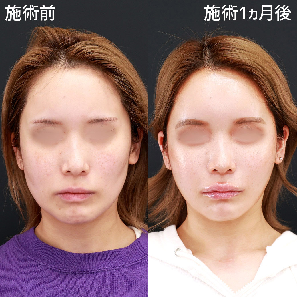【パーフェクトフェイスライン】ゴツゴツとした印象のフェイスラインを美しい卵型に