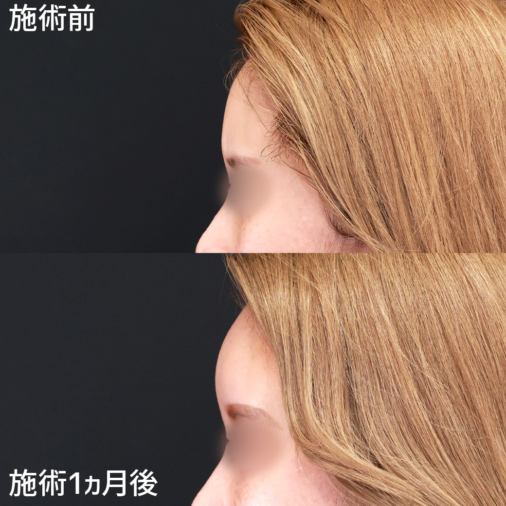 TAC式 ツヤ肌コラーゲンリフト®/ジョールファット除去/Lラインファット除去（エラ下脂肪除去）の症例写真 施術前後 