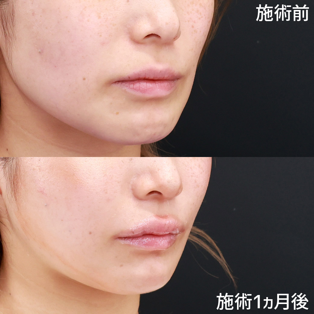 TAC式 ツヤ肌コラーゲンリフト®/ジョールファット除去/Lラインファット除去（エラ下脂肪除去）の症例写真 施術前後 