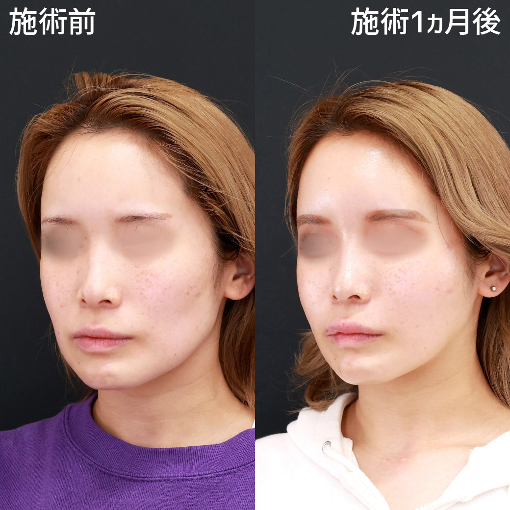 TAC式 ツヤ肌コラーゲンリフト®/ジョールファット除去/Lラインファット除去（エラ下脂肪除去）の症例写真 施術前後 