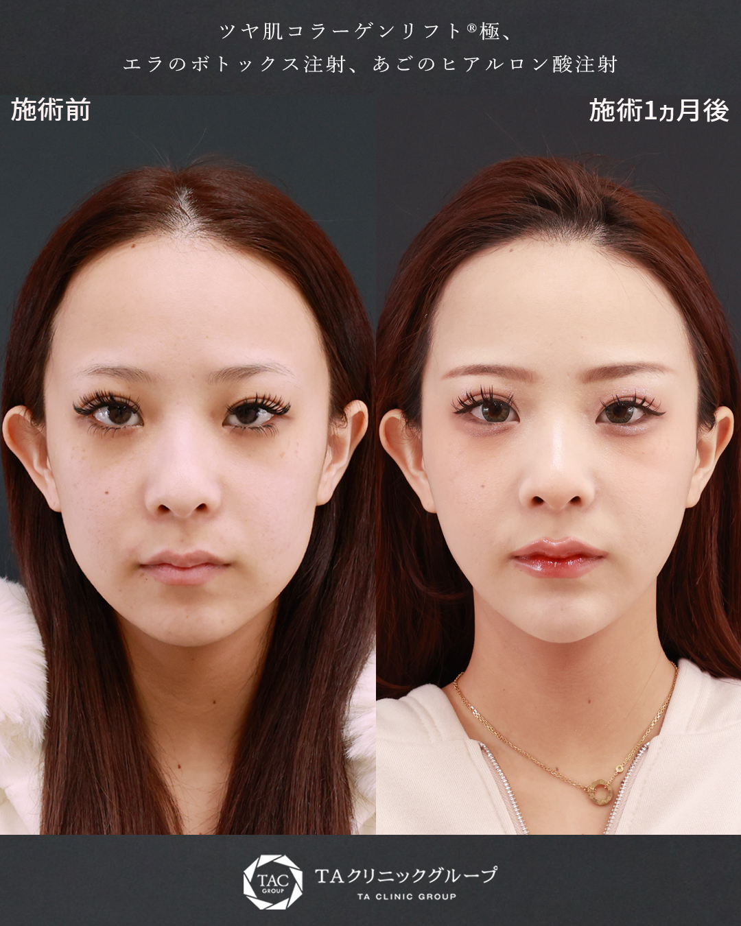 20代からの【糸リフト】たるみを引き上げてアプリ加工級の美しいフェイスラインに