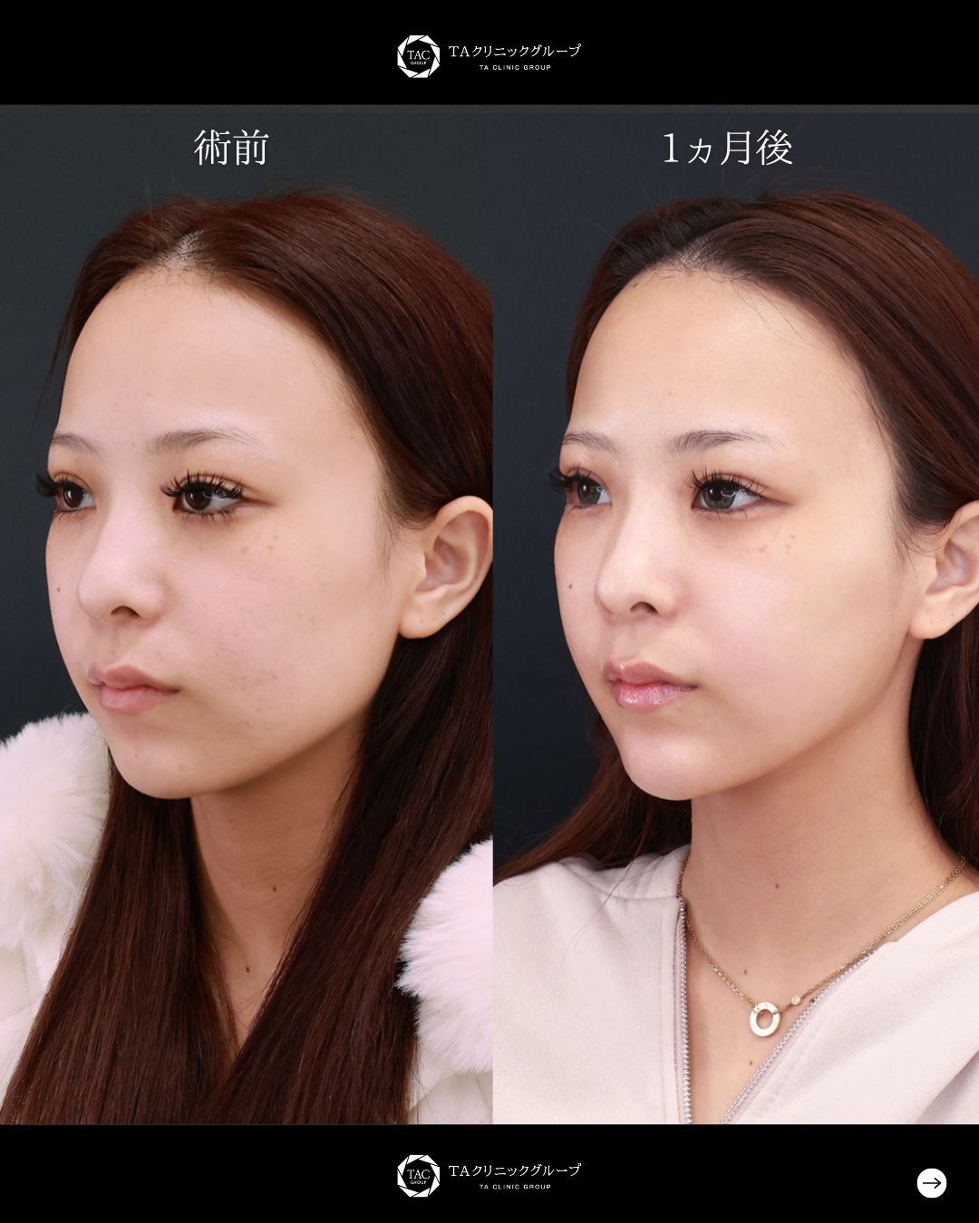 TAC式 ツヤ肌コラーゲンリフト®/エラボトックス注射/顎のヒアルロン酸注射の症例写真 施術前後 