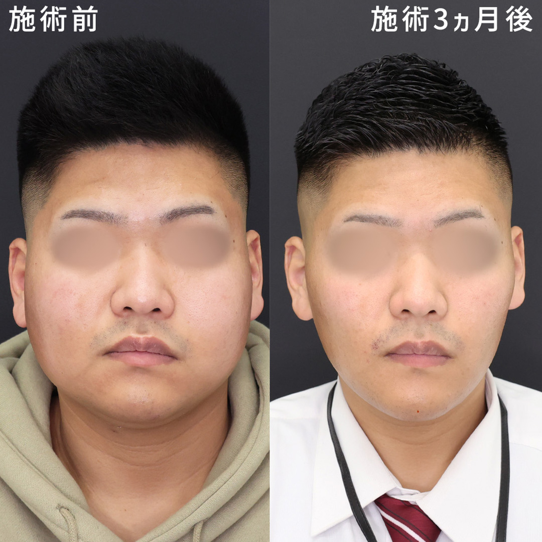 【別人級垢抜け術】男性の小顔術｜脂肪吸引×糸リフト