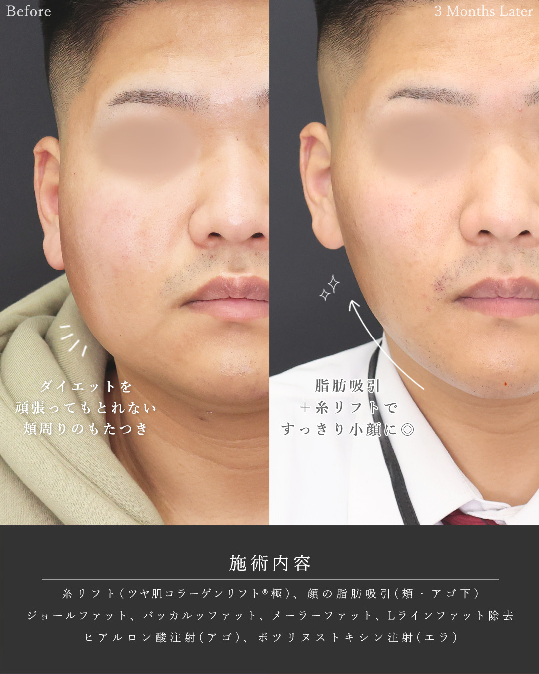 顎下の脂肪吸引/ジョールファット除去/バッカルファット除去の症例写真 施術前後 