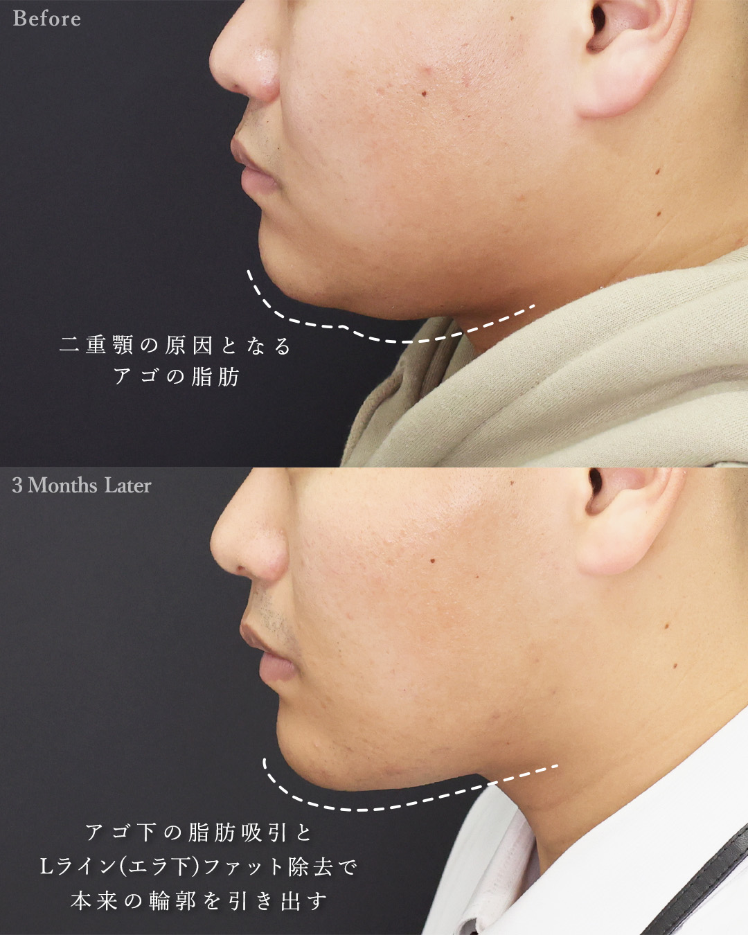 顎下の脂肪吸引/ジョールファット除去/バッカルファット除去の症例写真 施術前後 