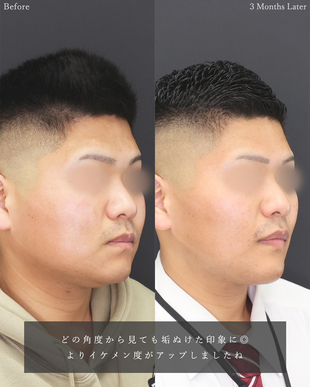 顎下の脂肪吸引/ジョールファット除去/バッカルファット除去の症例写真 施術前後 