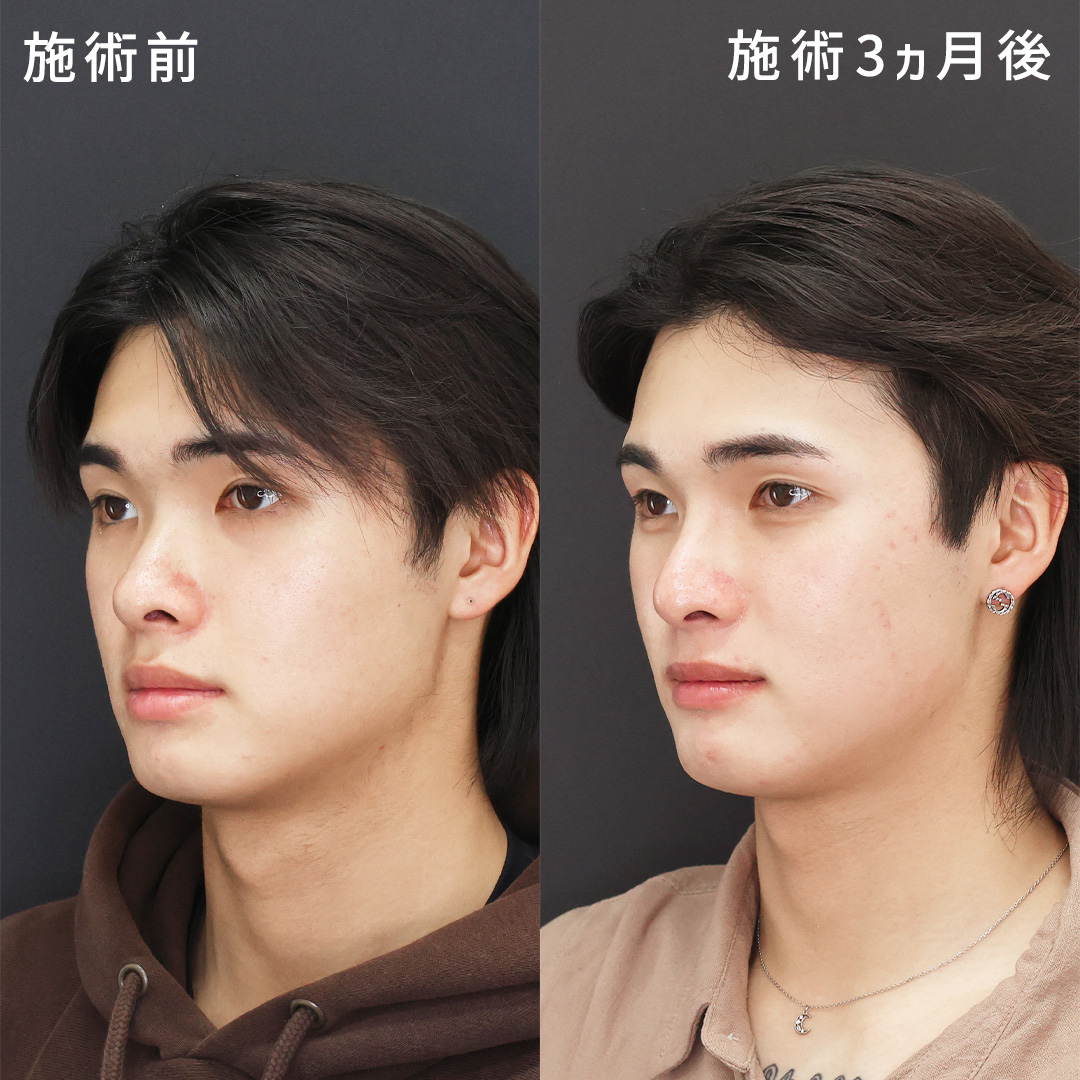 中学生からのコンプレックス解消｜メンズの鼻整形、口唇縮小術