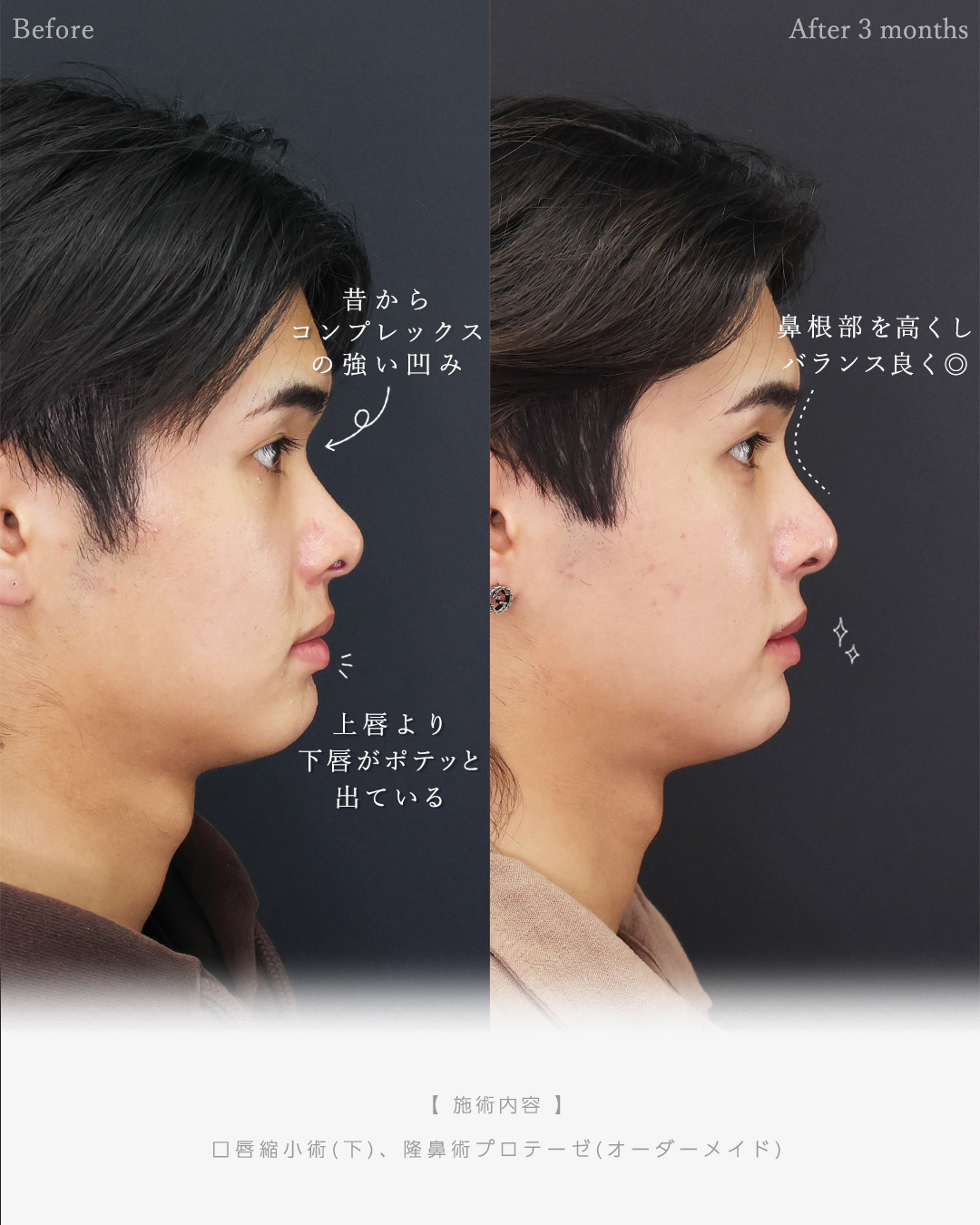 隆鼻術（プロテーゼ・自家組織）/口唇縮小術の症例写真 施術前後 