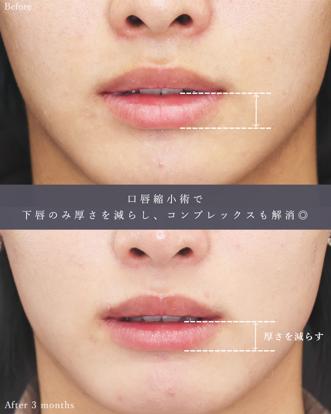 隆鼻術（プロテーゼ・自家組織）/口唇縮小術の症例写真 施術前後 