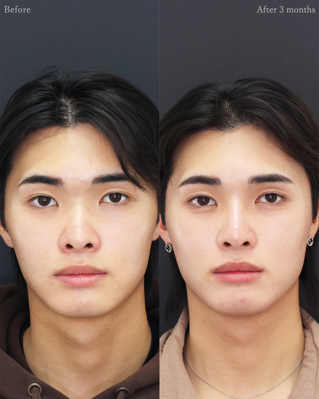 隆鼻術（プロテーゼ・自家組織）/口唇縮小術の症例写真 施術前後 