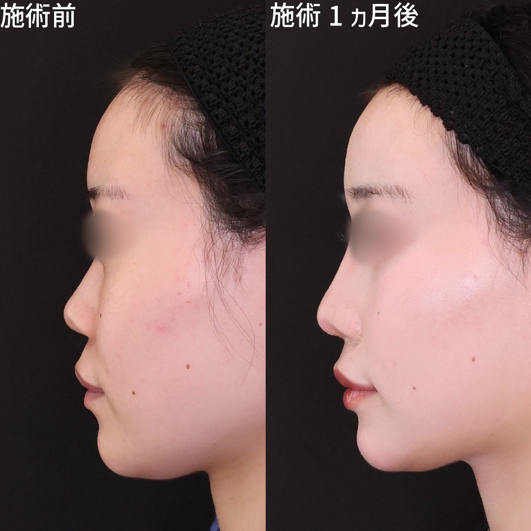 鼻先 低いの症例写真・画像・ビフォーアフター｜美容整形・美容