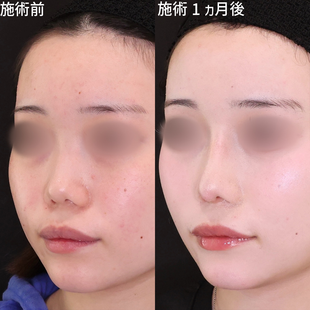 鼻尖形成・鼻尖縮小/隆鼻術（プロテーゼ・自家組織）/鼻先軟骨移植の症例写真 施術前後 