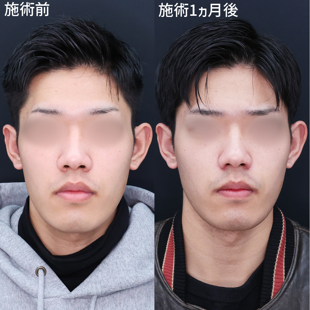 鼻孔縁挙上術/TAC式 鼻翼縮小術（小鼻縮小）の症例写真 施術前後 