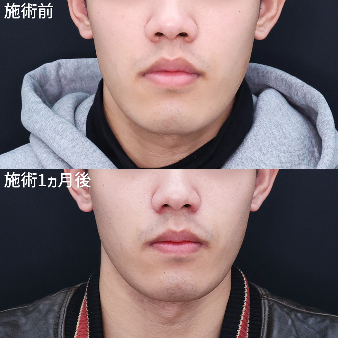 小鼻のふくらみを改善！よりバランスの整ったお鼻へ