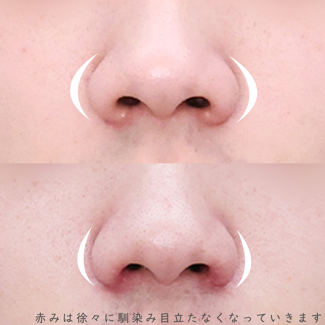 鼻孔縁挙上術/TAC式 鼻翼縮小術（小鼻縮小）の症例写真 施術前後 