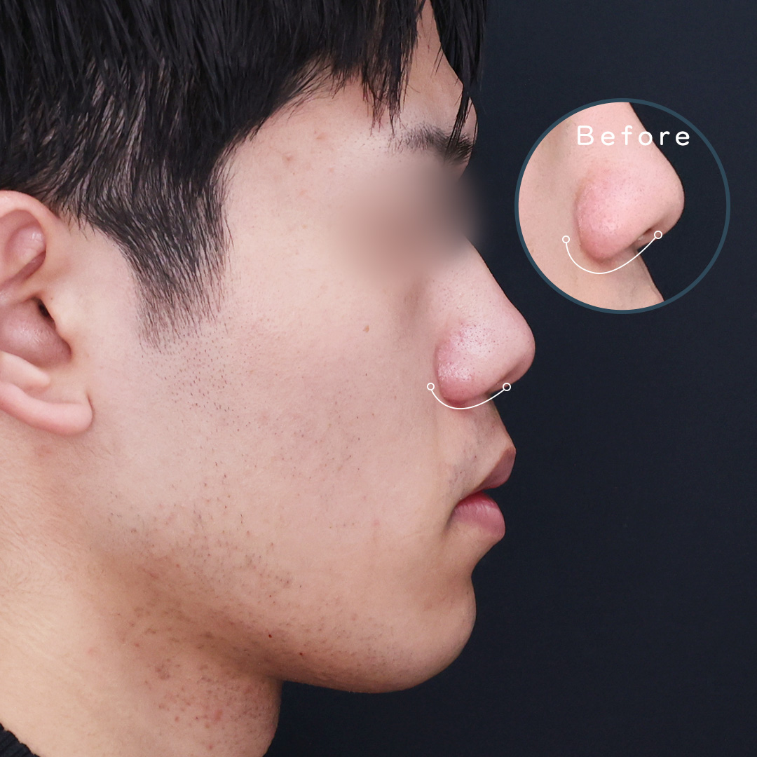 鼻孔縁挙上術/TAC式 鼻翼縮小術（小鼻縮小）の症例写真 施術前後 