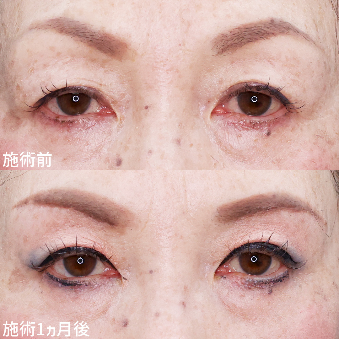 【眉毛下切開術】たるみ、間延びを解消◎若々しいお目元へ