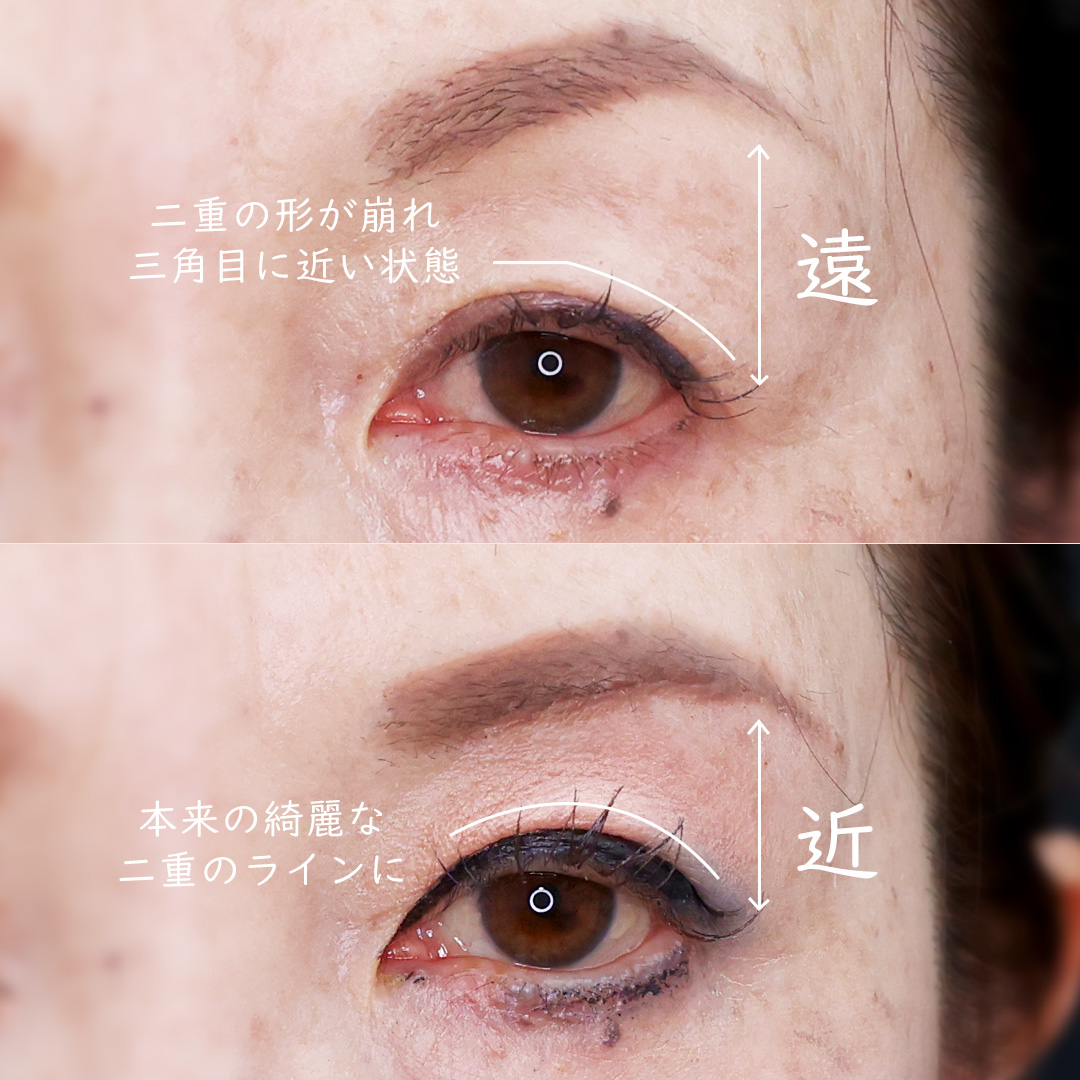 眉毛下切開術の症例写真 施術前後 