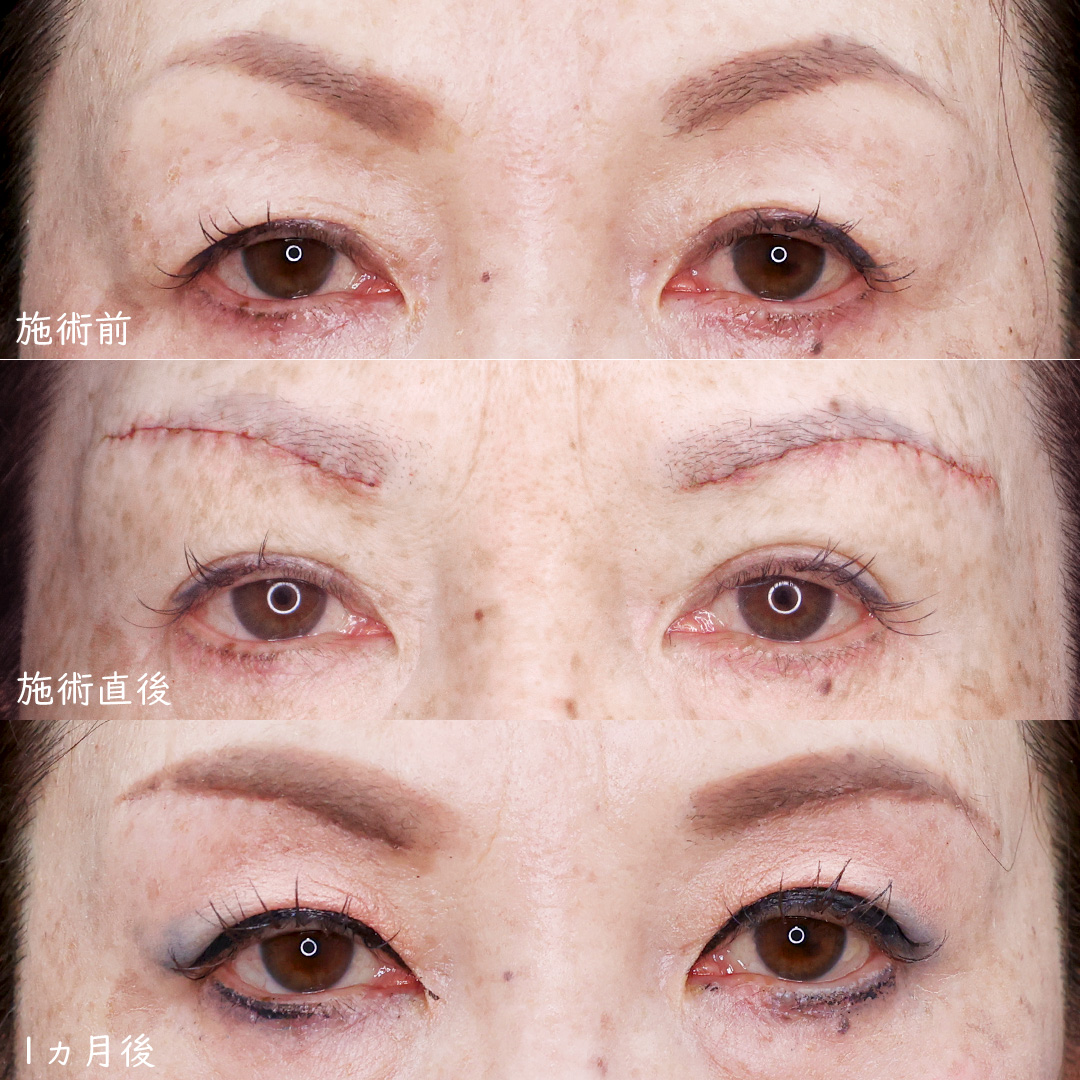 眉毛下切開術の症例写真 施術前後 