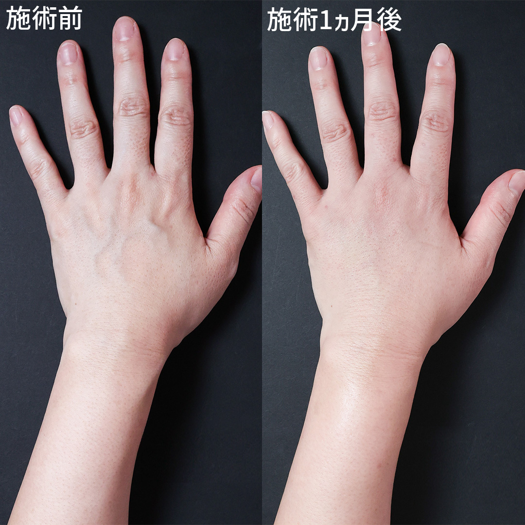 手の血管を無くし、更に綺麗なお手元に！