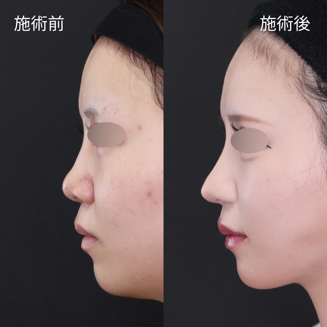 『究極の忘れ鼻』美人鼻の作り方
