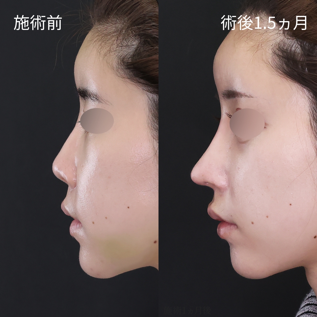 【鼻フル整形】美人は横顔が違う！