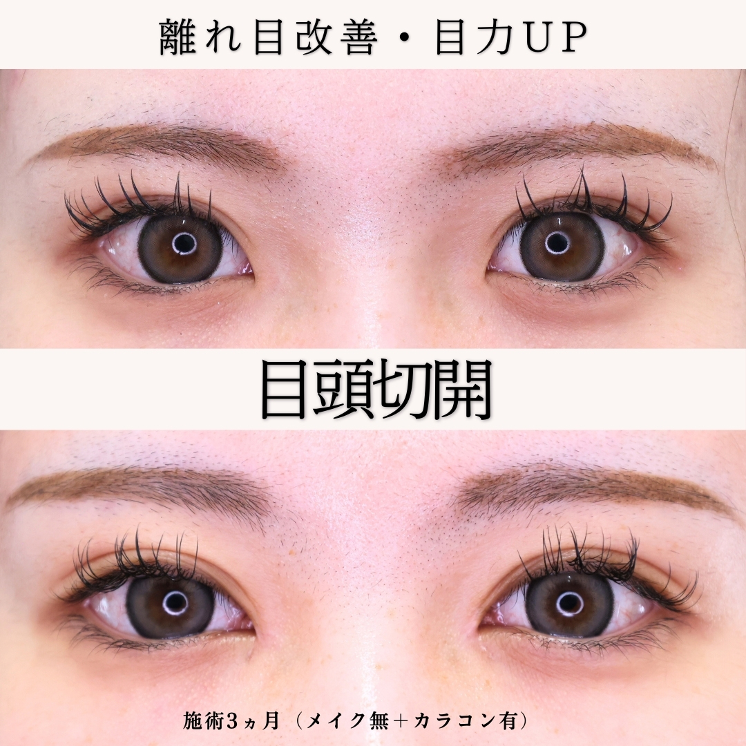 目頭切開術の症例写真 施術前後 