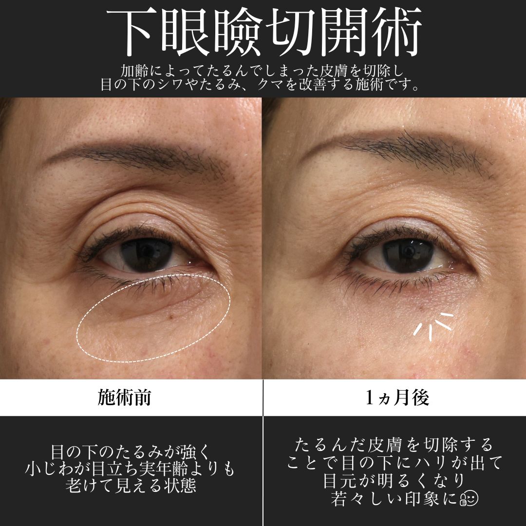 下眼瞼切開術（クマ・たるみとり）の症例写真 施術前後 