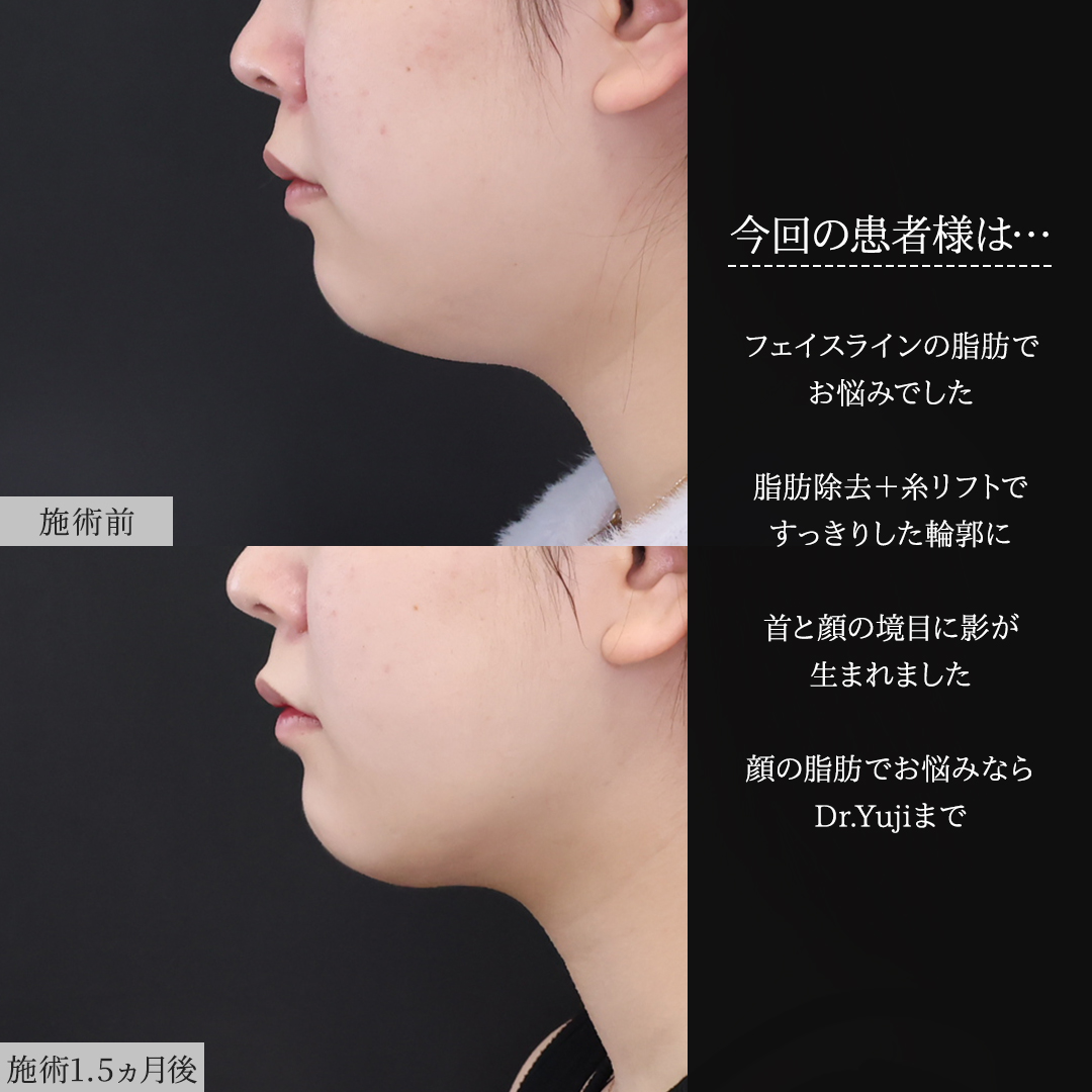 顎下の脂肪吸引/ジョールファット除去/TAC式 ツヤ肌コラーゲンリフト®の症例写真 施術前後 