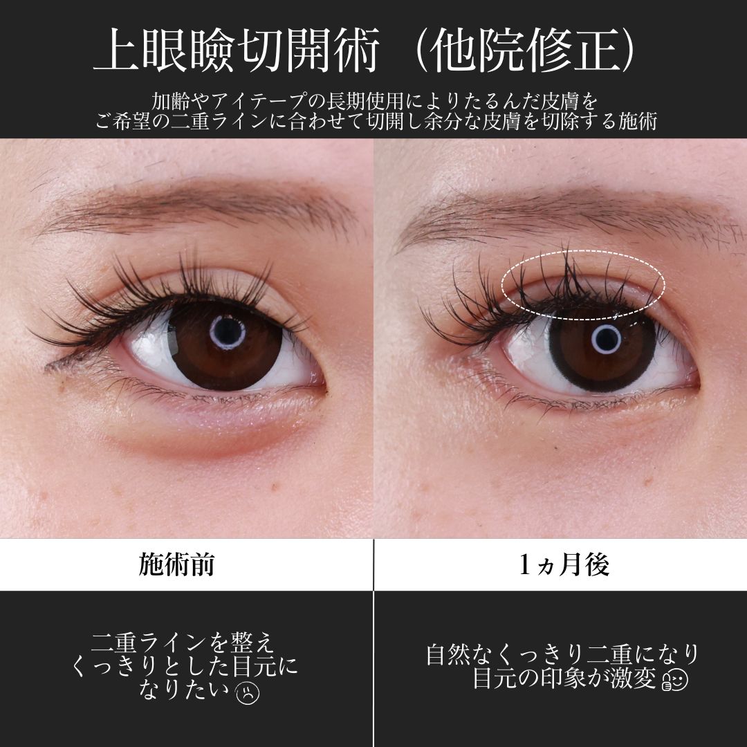 グラマラスライン（タレ目形成）/上眼瞼切開術/下眼瞼脱脂術（目の下のたるみ取り・目の下の脂肪ふくらみ取り）の症例写真 施術前後 