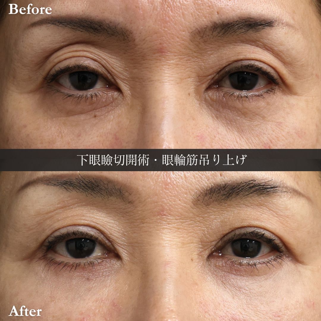 下眼瞼切開術（クマ・たるみとり）の症例写真 施術前後 
