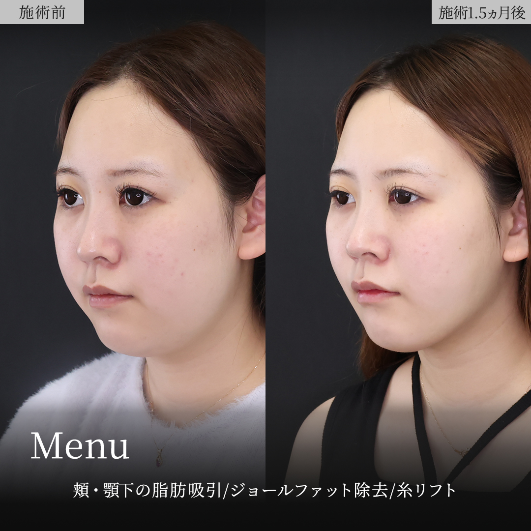 顎下の脂肪吸引/ジョールファット除去/TAC式 ツヤ肌コラーゲンリフト®の症例写真 施術前後 