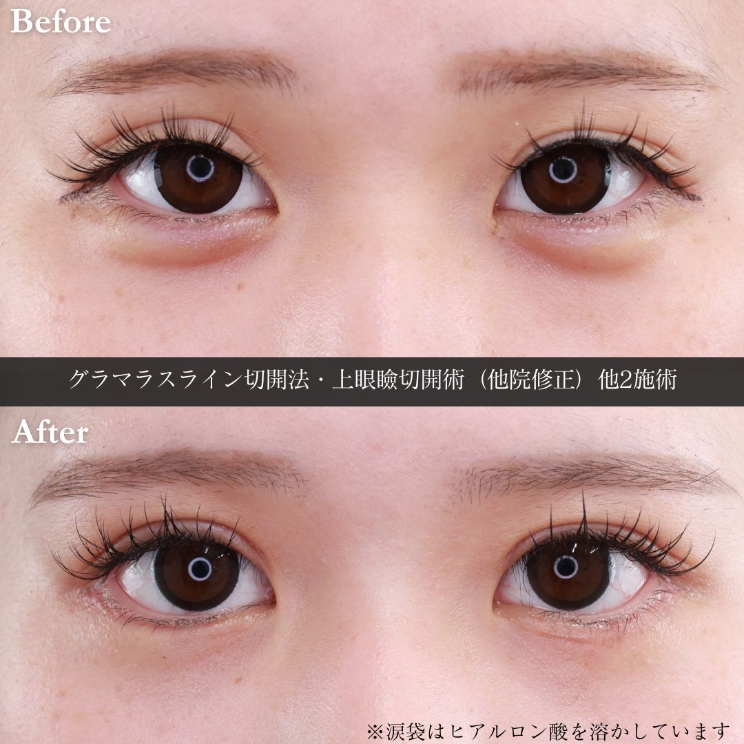 グラマラスライン（タレ目形成）/上眼瞼切開術/下眼瞼脱脂術（目の下のたるみ取り・目の下の脂肪ふくらみ取り）の症例写真 施術前後 